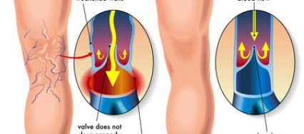 Solutions anti varices